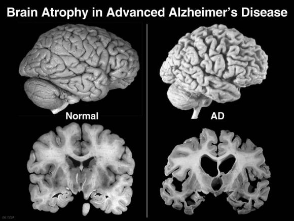 Сравнение мозга здорового человека и больного Альцгеймером