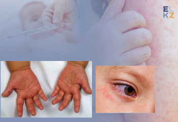 Кавасаки жұқпалы ауру емес 