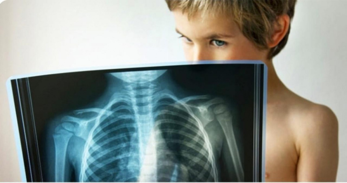 В Карагандинской области отмечается рост заболеваемости туберкулезом среди детей