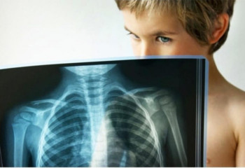 В Карагандинской области отмечается рост заболеваемости туберкулезом среди детей