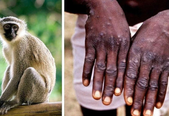 Түркияда маймыл шешегін жұқтыру дерегі тіркелді