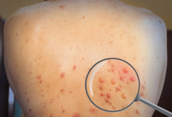 First case of smallpox infection revealed in Russia