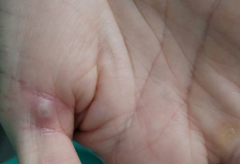 В ВОЗ считают, что распространение оспы обезьян можно остановить