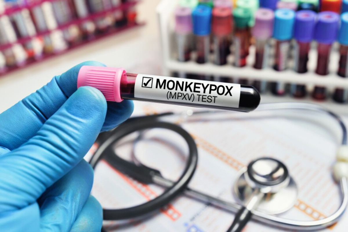 No cases reported – Giniyat on monkeypox in Kazakhstan