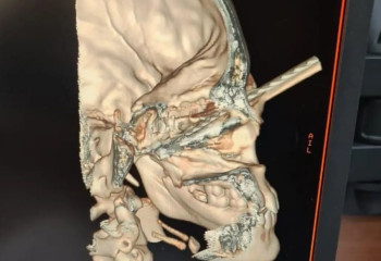 Акмолинские врачи спасли ребенка, вытащив проткнувший голову штырь