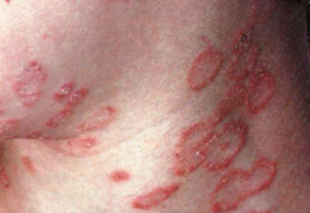 Қостанай облысында дерматомикоз дертіне 51 адам шалдыққан