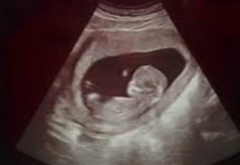 Денсаулық сақтау министрлігі ұрықтың днк диагностикасын енгізуге ниетті