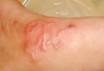 Паразита обнаружили под кожей у жителя Уральска