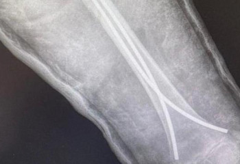 Врачи в Караганде с помощью «гибких гвоздей» лечат переломы у детей