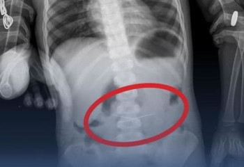 Тараздық дәрігерлер тігін инелерін жұтып қойған баланы құтқарды