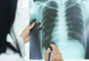 Соңғы бес жылда елімізде туберкулез ауруынан өлім-жітім 39,3 %-ға төмендеген