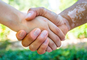 Almaty chosen as headquarters of World Vitiligo Day