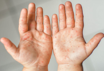 Түркістан облысында екпе алмаған 15 бала қызылша жұқтырды