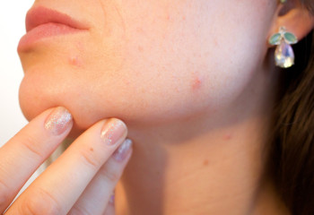 Алматыда 73 адам қызылша жұқтырды