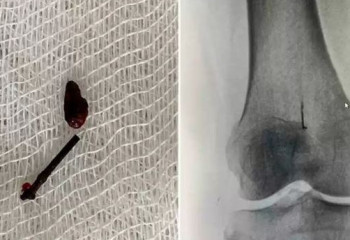 Алматылық әйелдің тізесіне кірген ине 45 жылдан кейін алынды