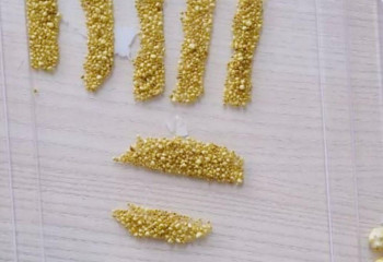 Свыше 1,7 тысячи камней извлекли хирурги из желчного пузыря алматинки