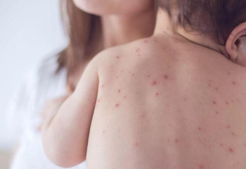 В Атырауской области у троих детей диагностирована корь