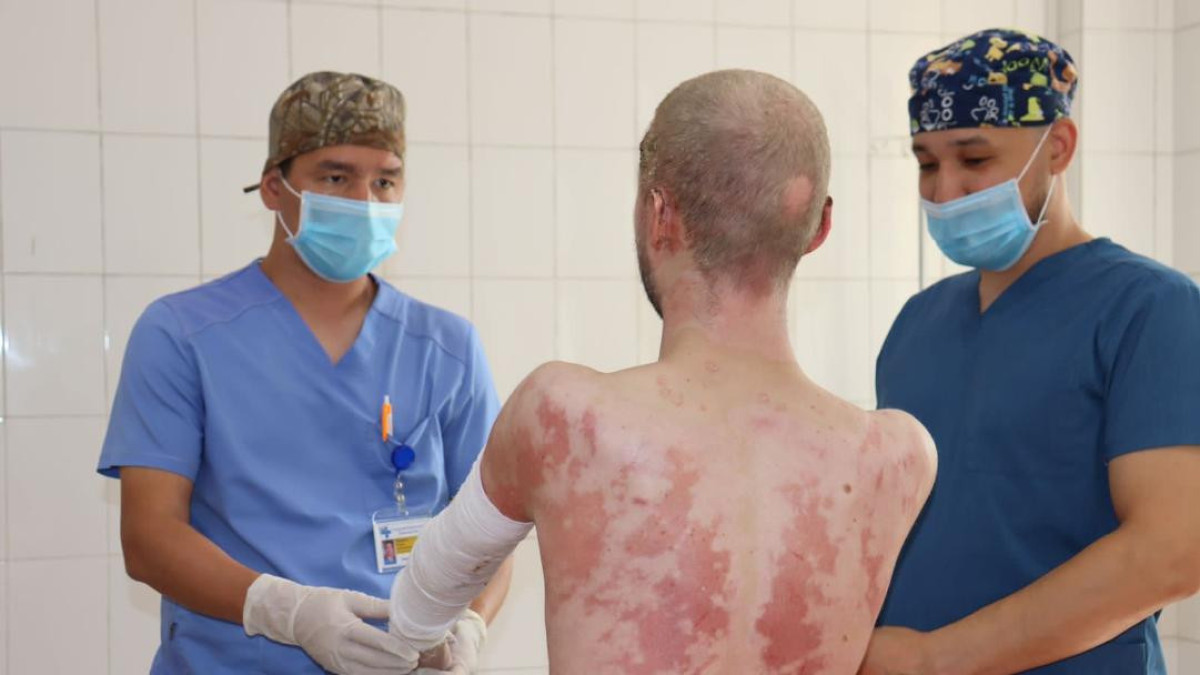 Алматинские врачи спасли пациента с 94 процентами ожогов тела