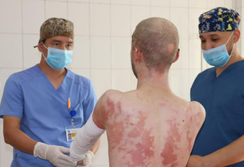 Алматинские врачи спасли пациента с 94 процентами ожогов тела
