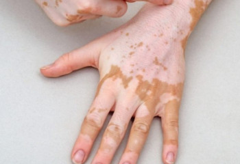 Highly effective methods of treating vitiligo introduced in Kazakhstan