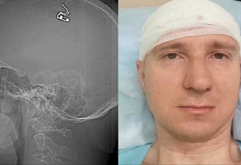 Алматыға көшіп келген ресейлік азамат басына чип орнатқан