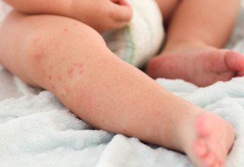 Қазақстанда 4 мыңнан астам адам қызылша дертін жұқтырған