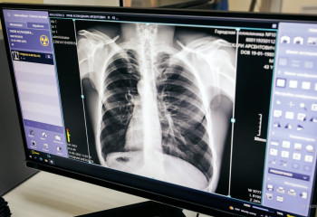 Қазақстанда туберкулезбен сырқаттану көрсеткіші екі есе төмендеді