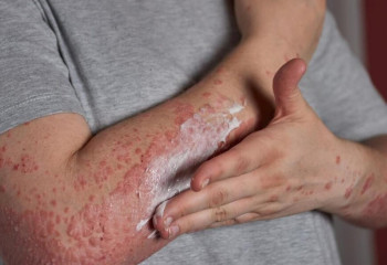 ДСМ: Елімізде псориазды емдеу үшін дәрі-дәрмек тегін беріледі