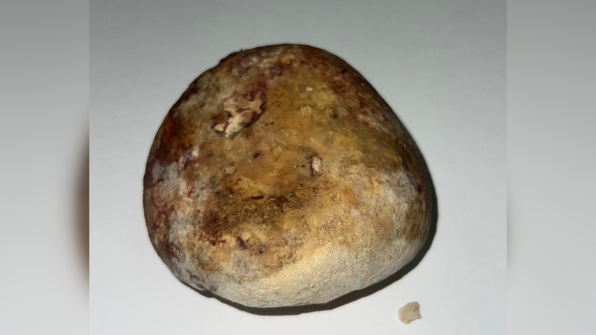 Молодому мужчине извлекли огромный «камень» из прямой кишки алматинские врачи