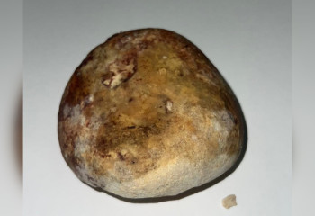 Молодому мужчине извлекли огромный «камень» из прямой кишки алматинские врачи