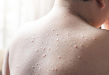 Привлечь к ответственности антиваксеров: в Казахстане создали петицию в связи со вспышкой кори