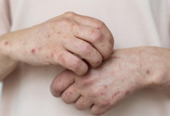 Впервые корь открыл мусульманин - вирусолог