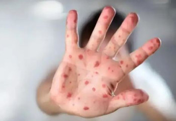 Казахстан оказался в тройке лидеров по заболеваемости корью в мире