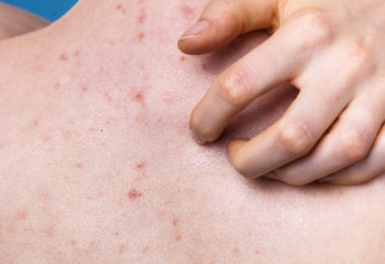 Қазақстан әлемде қызылша жұқтырудан алдыңғы орынға шықты