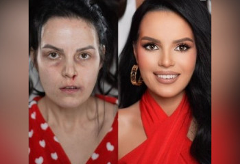 Муж отрубил ей топором в лесу кисти рук, но она выжила – как сегодня живет женщина, пережившая страшную трагедию