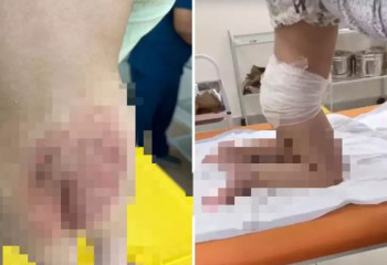 Екі жасар қызды оңбай күйдіріп алған балабақша тәрбиешісі жұмыстан қуылды