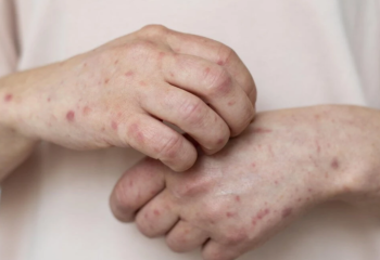 Түркістан облысында 2 мыңнан аса адам қызылша жұқтырған