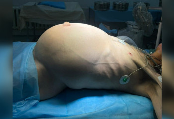 Мужчину с огромным «беременным» животом прооперировали ведущие хирурги Алматы