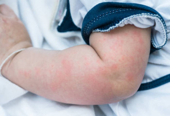 Қызылша баланы мүгедек етуі мүмкін – педиатр