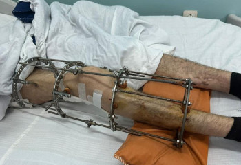 Алматылық дәрігелер үш  күрделі ота жасау арқылы ер адамды аяққа тұрғызды