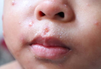 Қызылша жұқтырған бес бала жансақтау бөліміне түсті