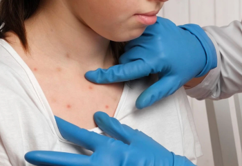 Түркістанда жыл басынан бері вакцинадан бас тартқан 47 адам қызылшамен ауырған