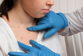 Елімізде қызылша жұқтыру жағдайы төмендеді