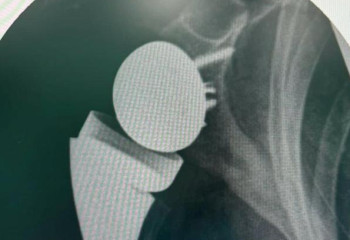 Алматы облысында тірек-қимыл жүйесін емдеудің заманауи тәсілдері енгізілді