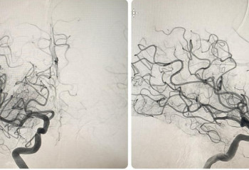 Трёхсантиметровый тромб вытащили из мозга пенсионерки алматинские нейрохирурги