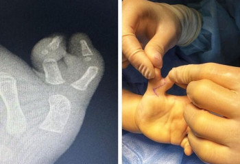 Девочка из Алматы с шестью пальцами на руке была прооперирована врачами