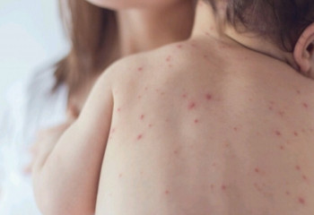 Қызылша жұқтырудың қаупі: адам соқыр болып қалуы мүмкін