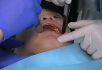 Ақтөбелік дәрігер қоянжырықпен туған 5 мың балаға операция жасаған