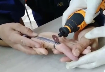 Застрявшее на пальце кольцо пришлось снимать спасателям с руки ученика