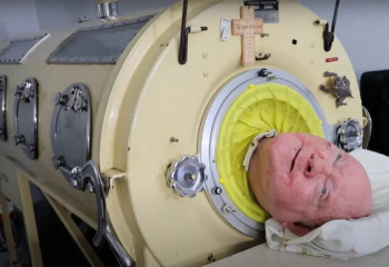 Последний человек с «железными легкими» скончался в возрасте 78 лет